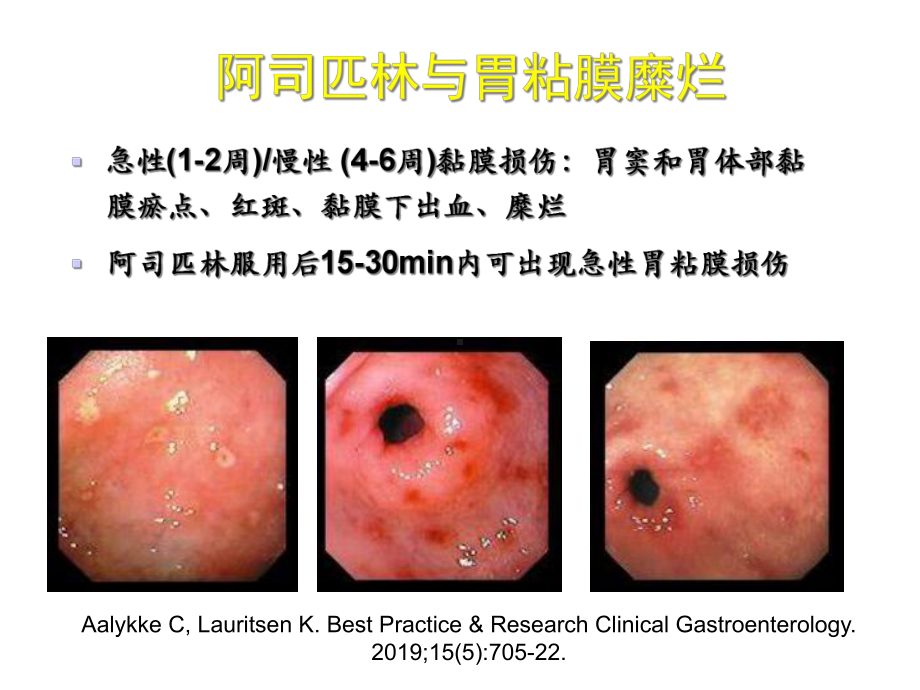 NSAIDs相关性胃粘膜损伤的防治课件.ppt_第3页