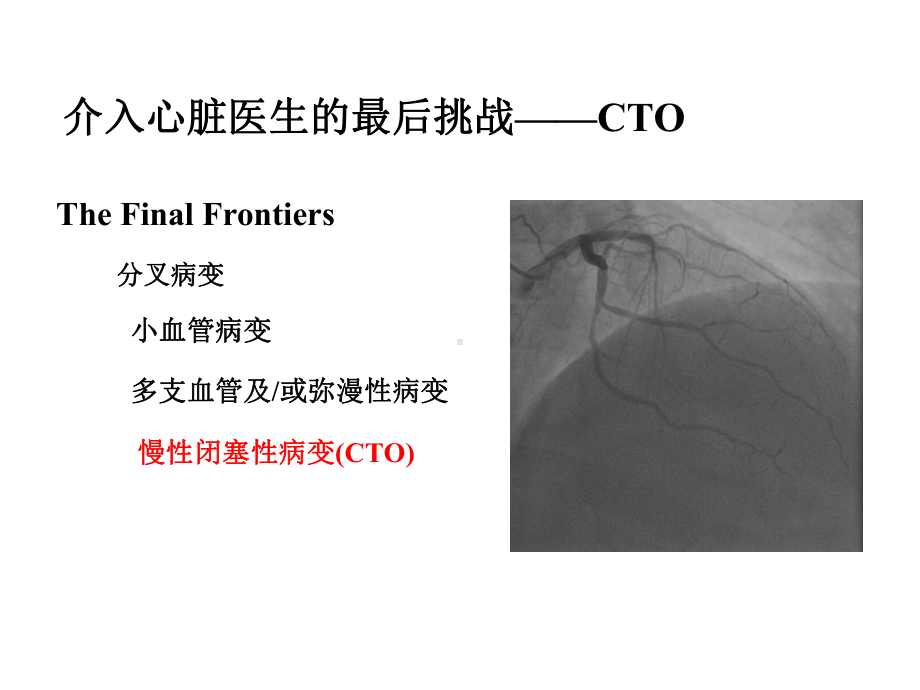 CTO介入治疗处理流程与专家共识2021优秀课件.pptx_第2页