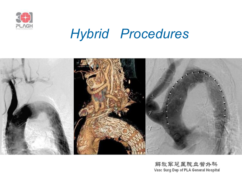 主动脉弓复杂病变HybridChimneyorelse医学课件.ppt_第3页