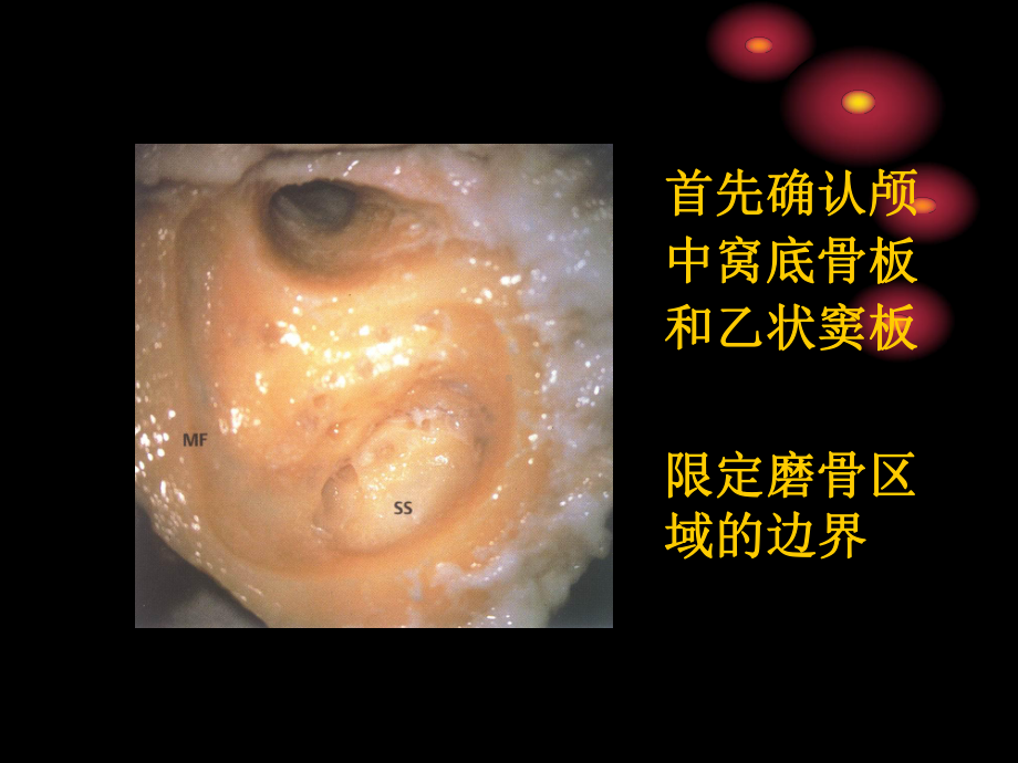 乳突手术解剖课件.ppt_第2页