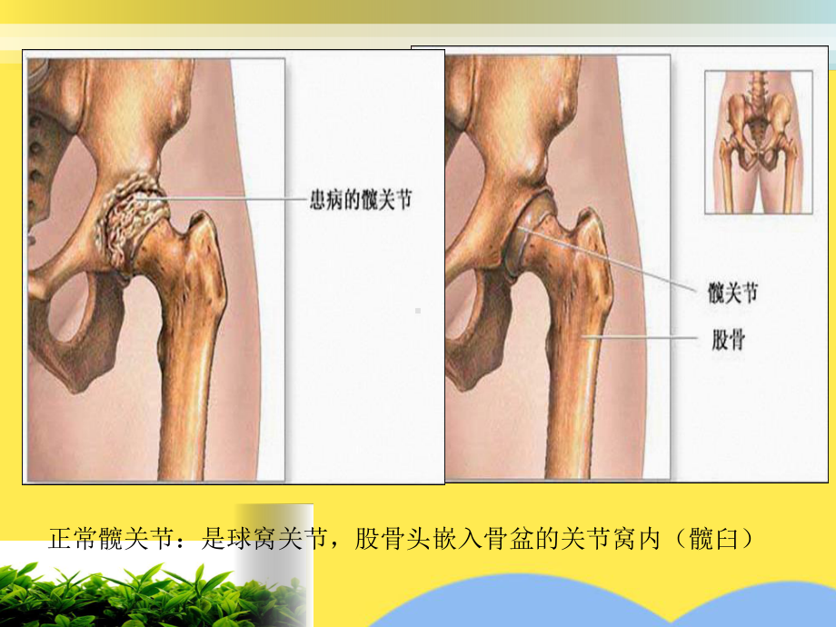 人工髋关节置换术后的护理进展(“髋关节”相关)共30张课件.pptx_第2页