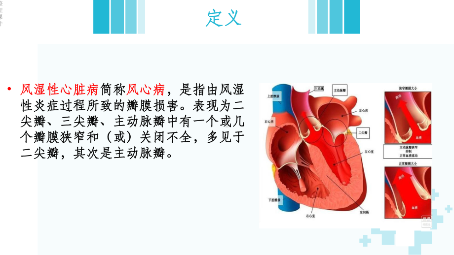 《风湿性心脏病》课件.ppt_第2页