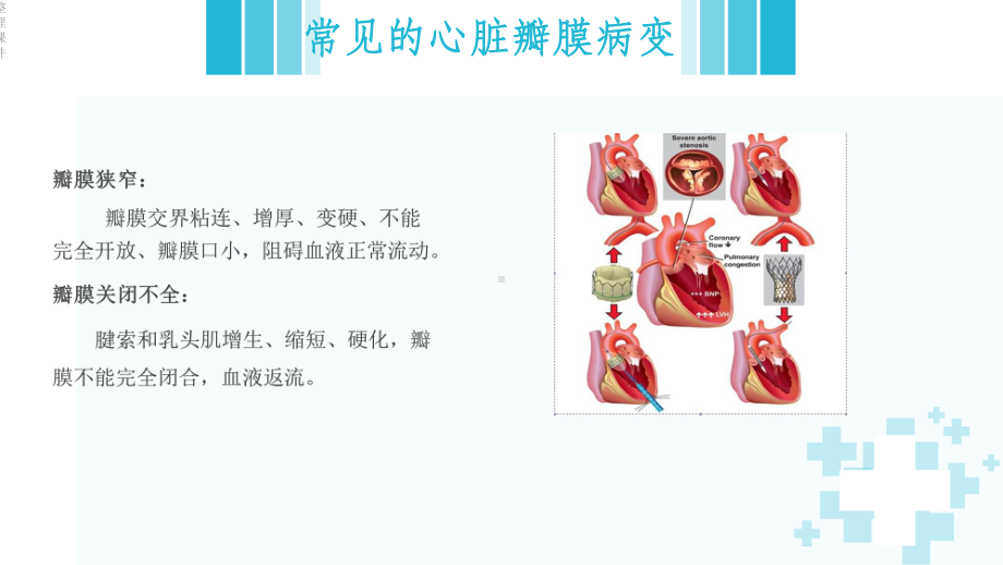 《风湿性心脏病》课件.ppt_第3页