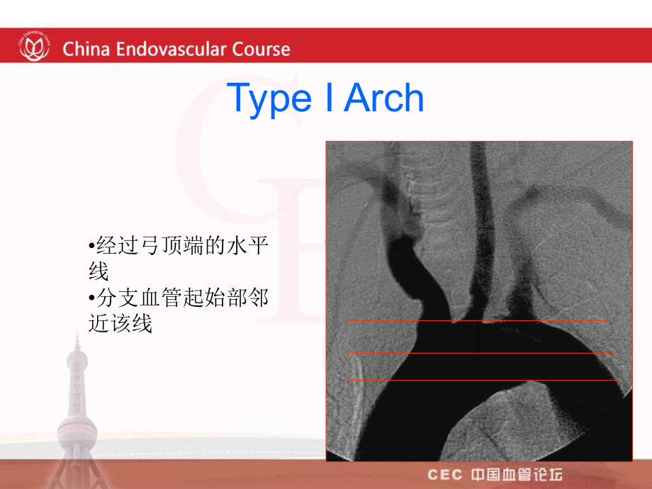 主动脉弓和颈动脉解剖与cas操作技巧医学课件.ppt_第3页