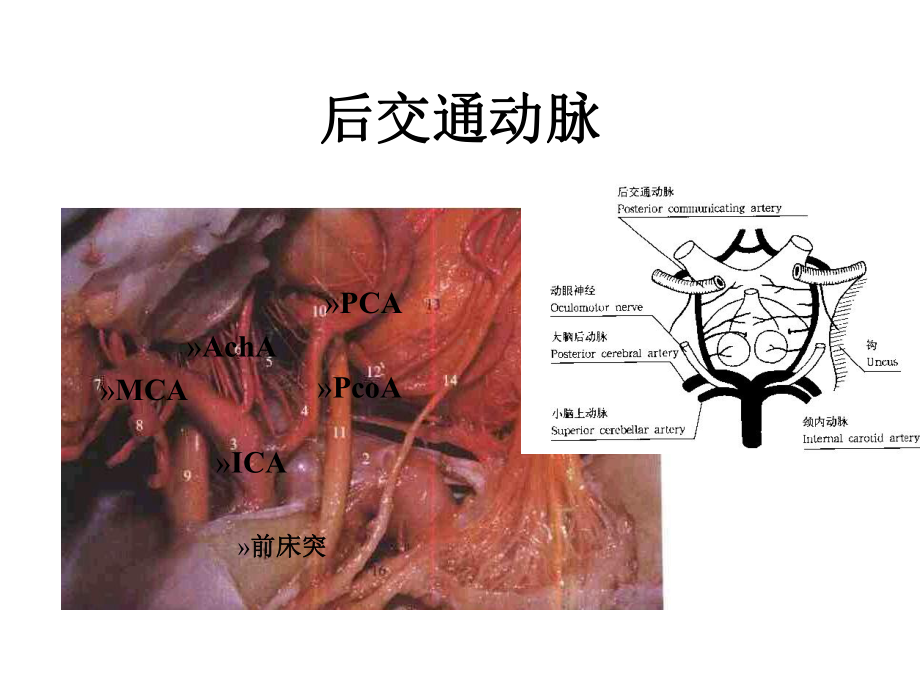 丘脑底节区脑血管解剖医学课件.ppt_第3页