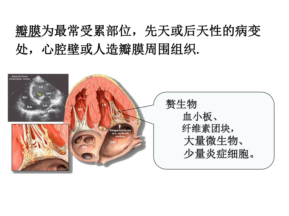 感染性心内膜炎护理查房(共26张)课件.pptx_第3页