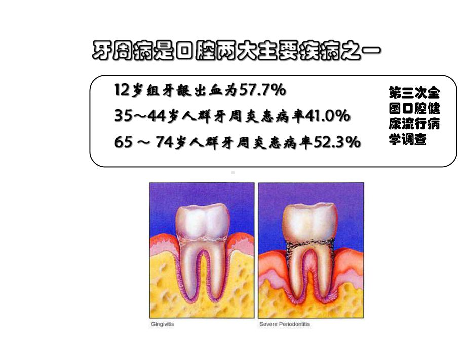 牙周病的修复治疗优质课件.ppt_第2页