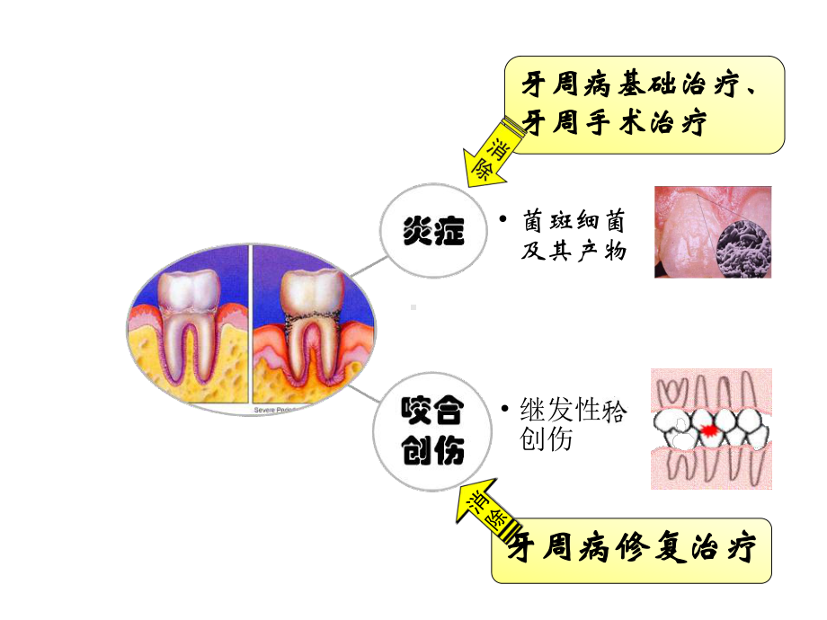 牙周病的修复治疗优质课件.ppt_第3页