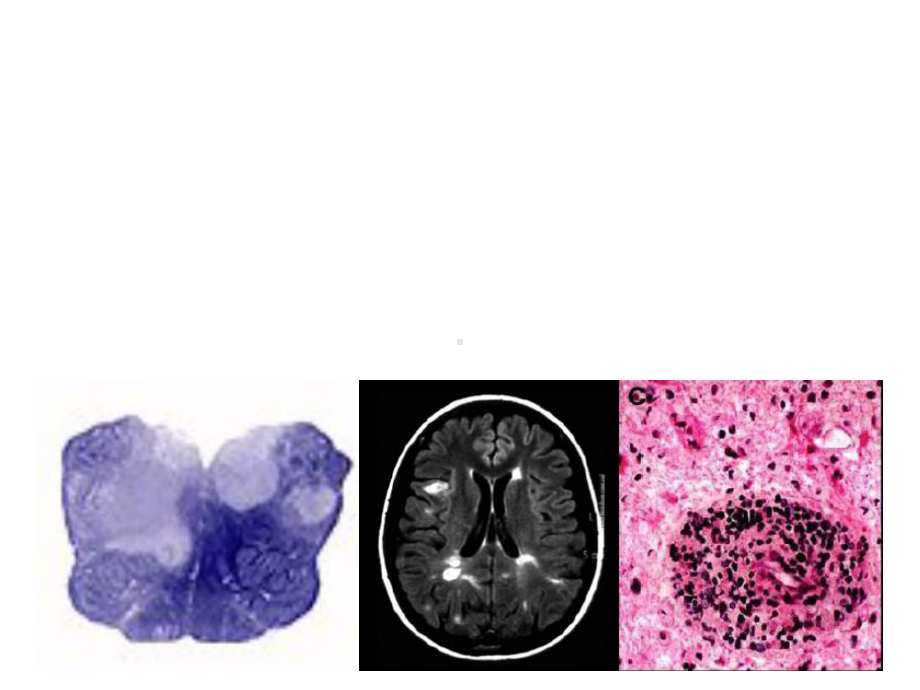 多发性硬化的诊断与治疗课件.ppt_第1页