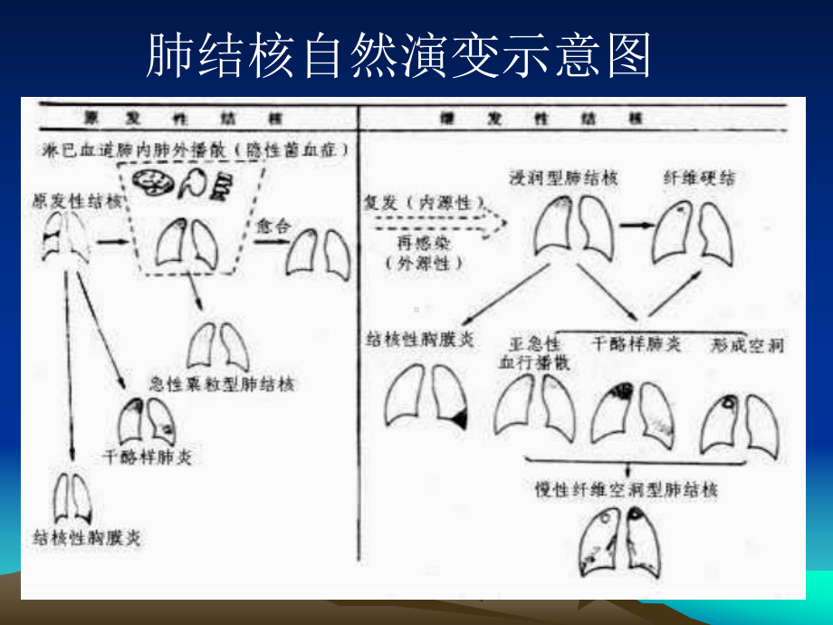 儿童结核病课件.ppt_第3页