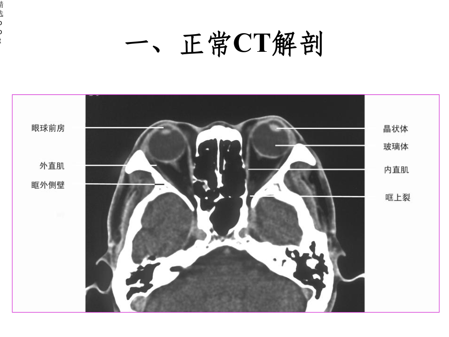 眼及眼眶影像诊断课件.ppt_第2页