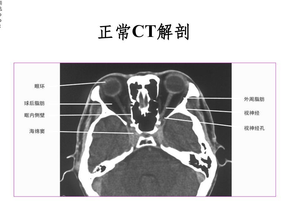 眼及眼眶影像诊断课件.ppt_第3页