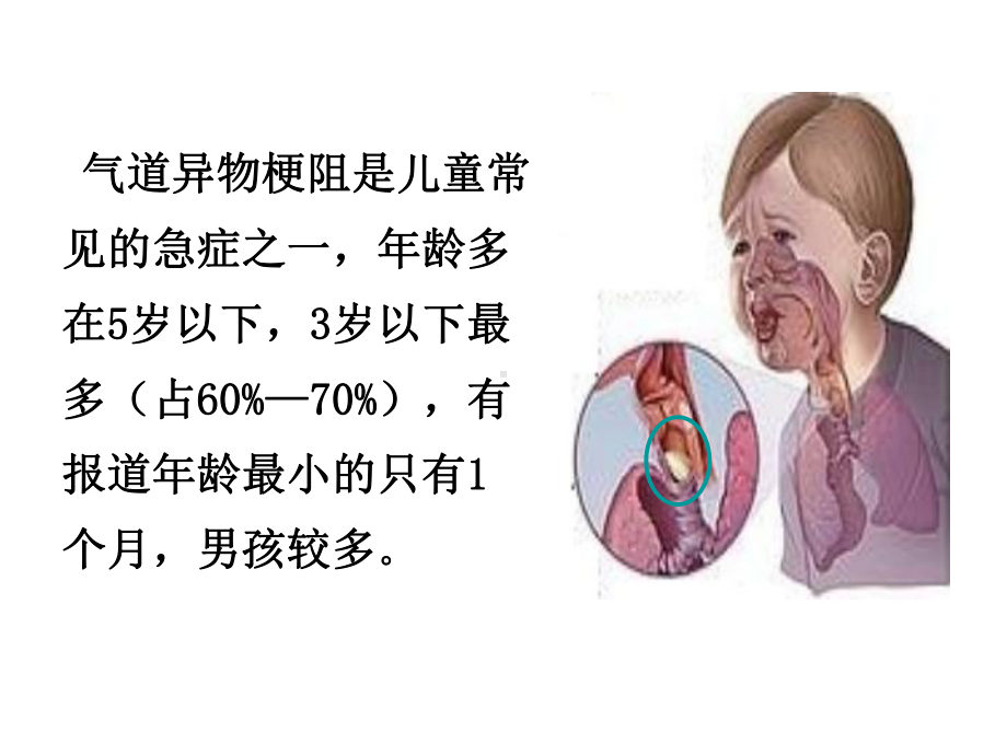 学前儿童气管异物的的紧急救助共46张课件.ppt_第2页