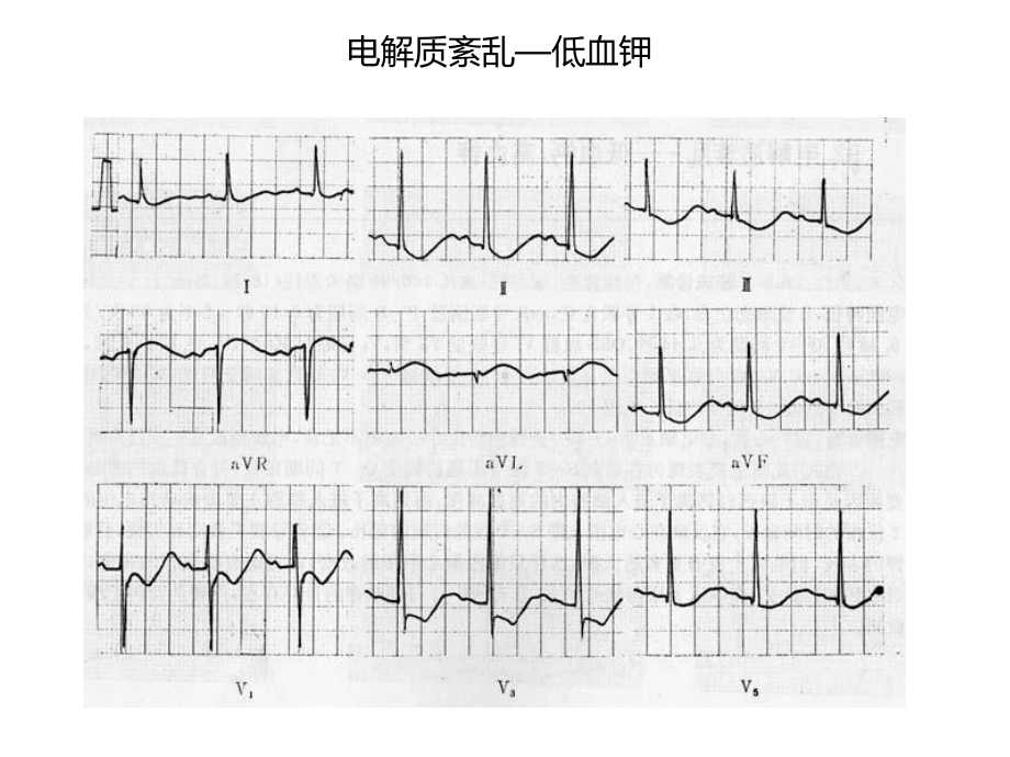 心电图及影像考试题答案课件.ppt_第3页