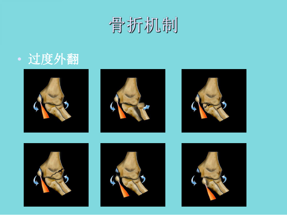 儿童肘关节骨折的X线诊断(共48张)课件.pptx_第3页