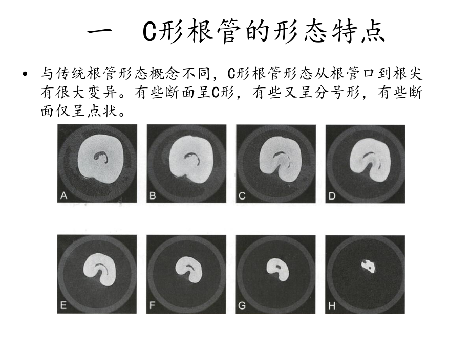 C形根管的分类及治疗课件.ppt_第3页