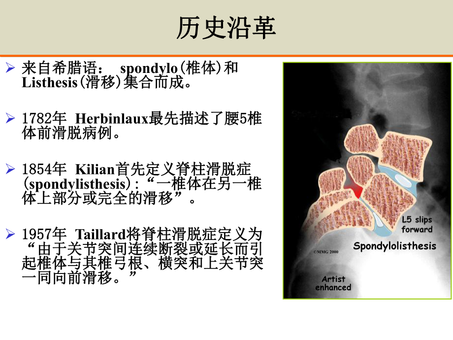 微创与开放手术治疗III度腰椎滑脱症课件.ppt_第2页