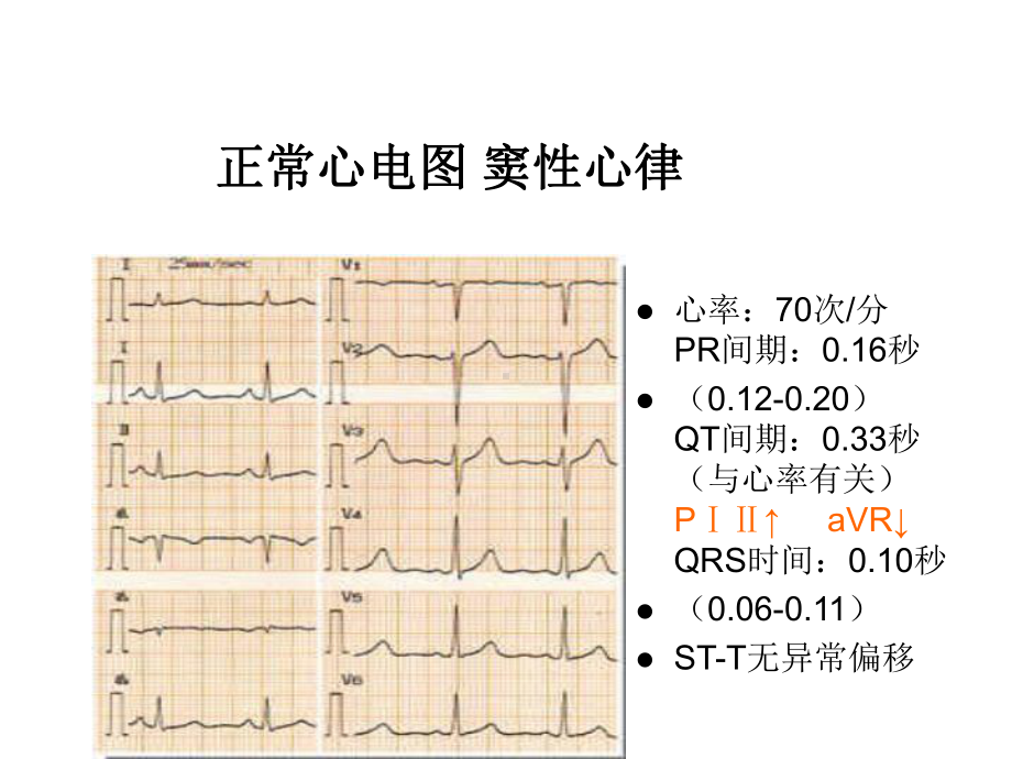 常见异常心电图课件.ppt_第3页