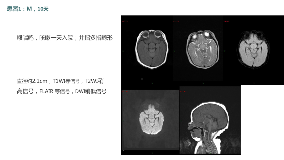 灰结节错构瘤(共28张)课件.pptx_第3页