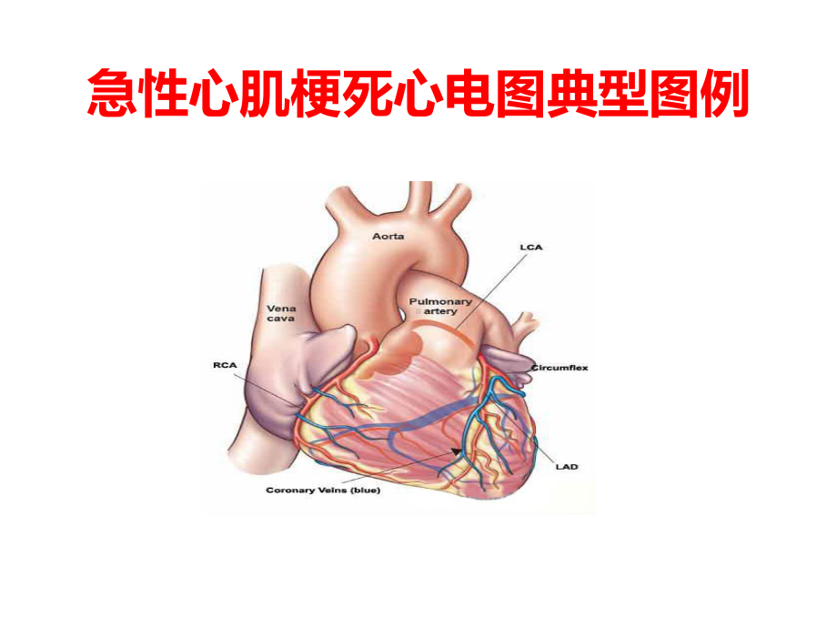 急性心肌梗死及常见心电图识别课件.ppt_第2页