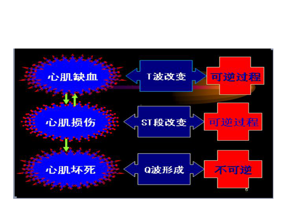 急性心肌梗死及常见心电图识别课件.ppt_第3页