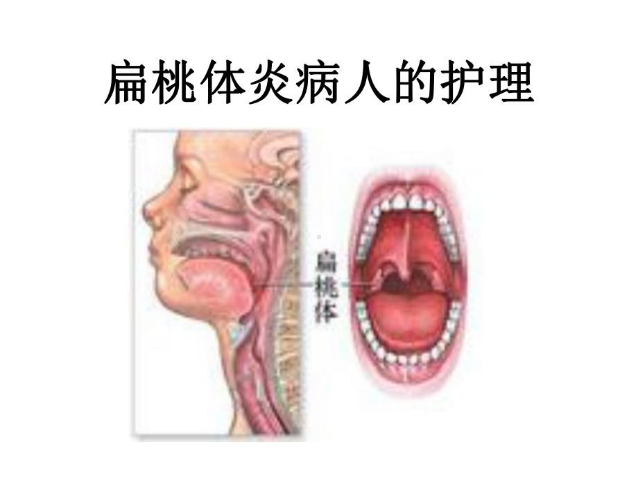 咽科病人的护理医学课件.ppt_第2页