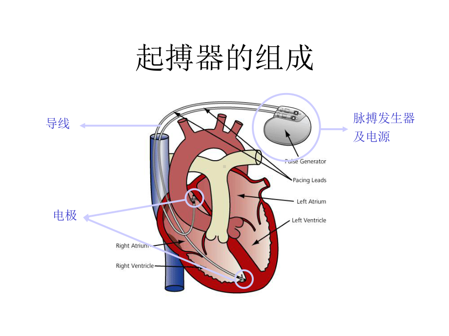 心外-临时起搏器课件.ppt_第3页