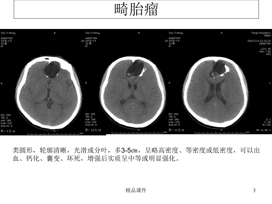 典型病例影像表现医学课件.ppt_第3页