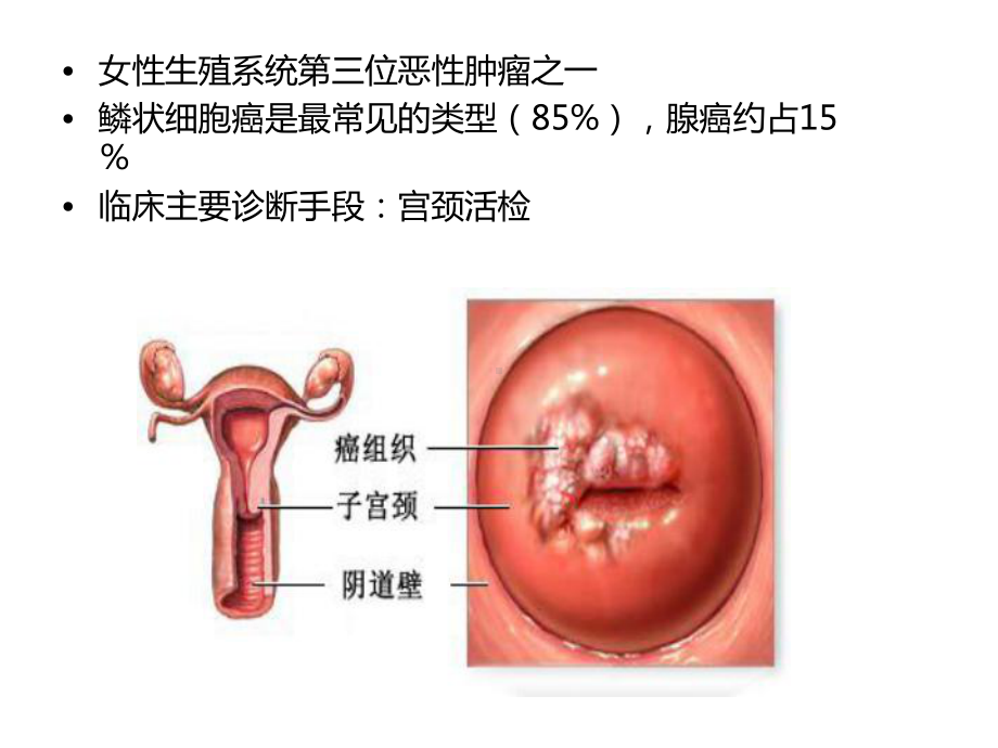 宫颈癌靶区勾画课件.pptx_第2页