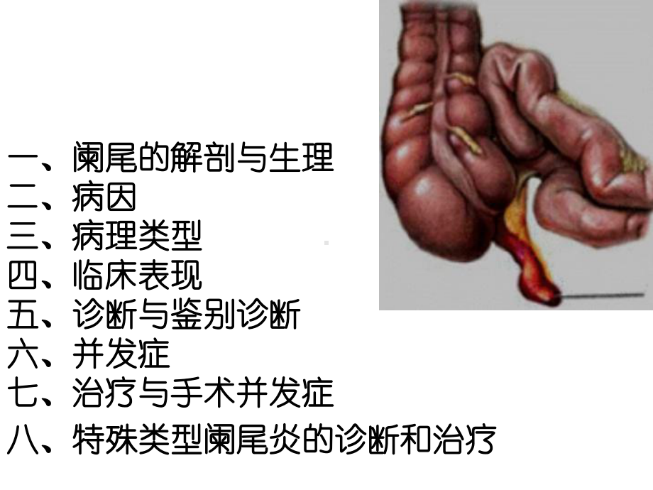 急性阑尾炎教学查房课件.ppt_第2页