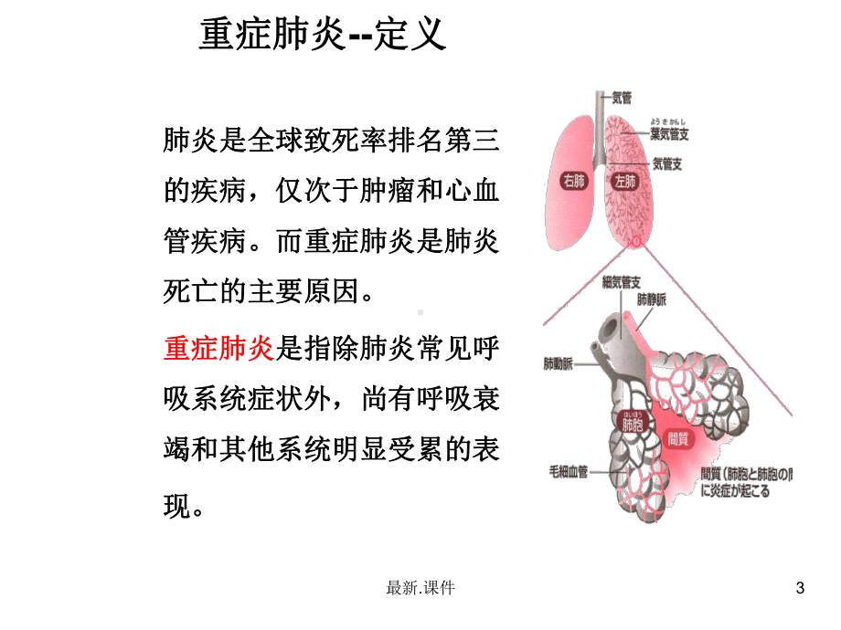 归纳重症肺炎护理个案课件.ppt_第3页