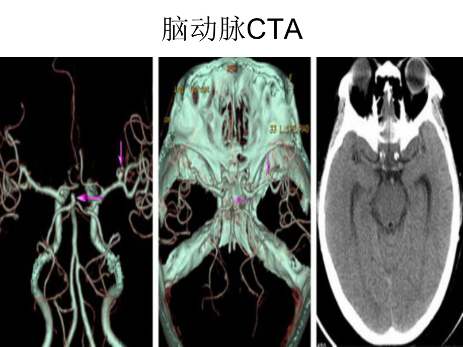 多排螺旋CT的临床(2)医学课件.ppt_第3页