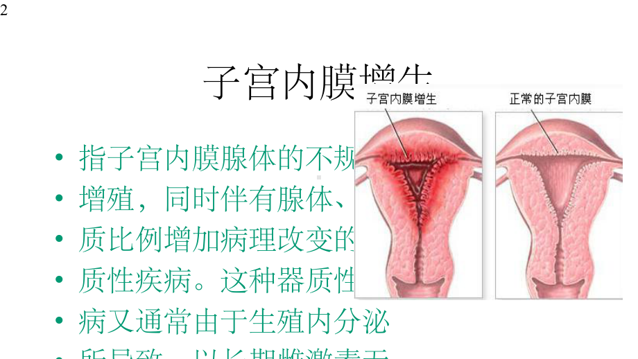 子宫内膜增生课件.pptx_第2页