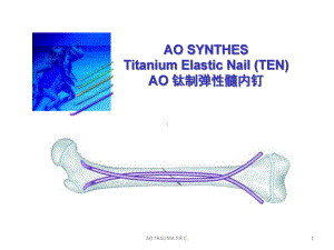 弹性髓内钉治疗儿童长骨骨折课件.ppt