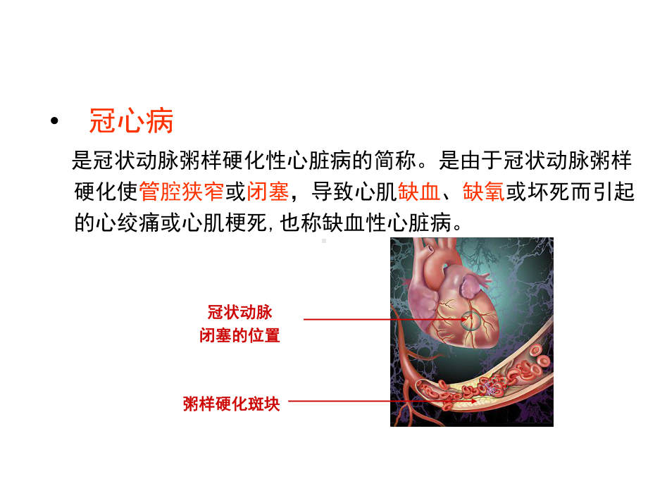 心肌梗死健康宣教39328课件.ppt_第2页