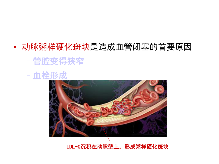 心肌梗死健康宣教39328课件.ppt_第3页