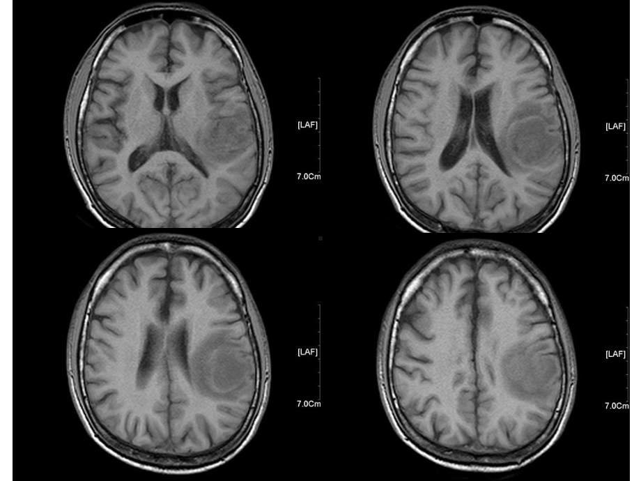 影像科经典读片之三：脑淋巴瘤课件.ppt_第3页