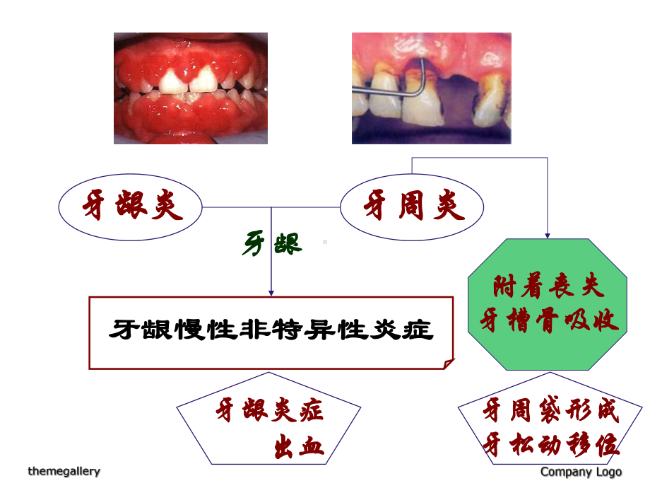 牙周病学牙周病的主要症状和临床病理课件.ppt_第2页