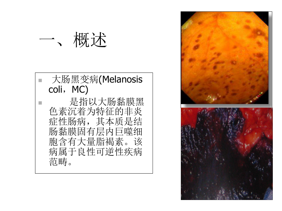 大肠黑变病课件.ppt_第2页