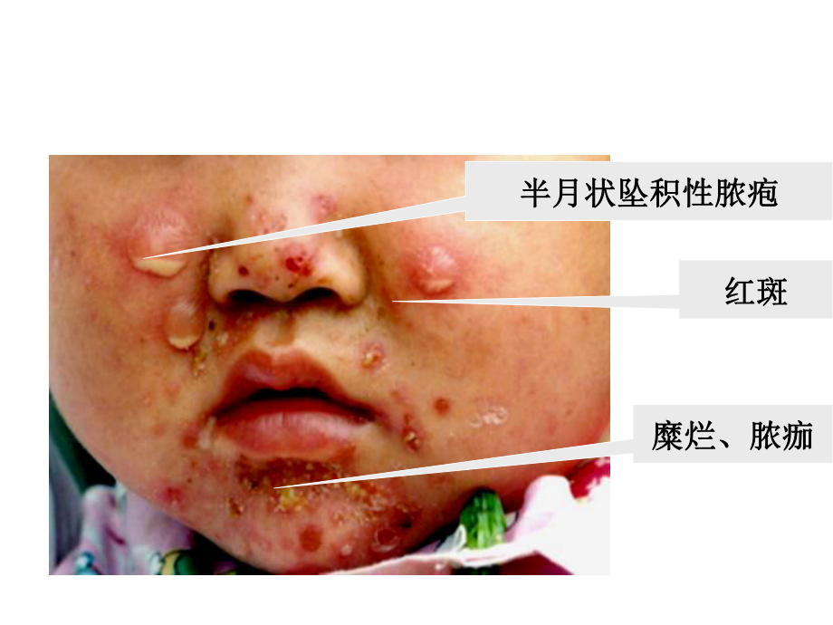 黄水疮、癣共59张课件.ppt_第2页