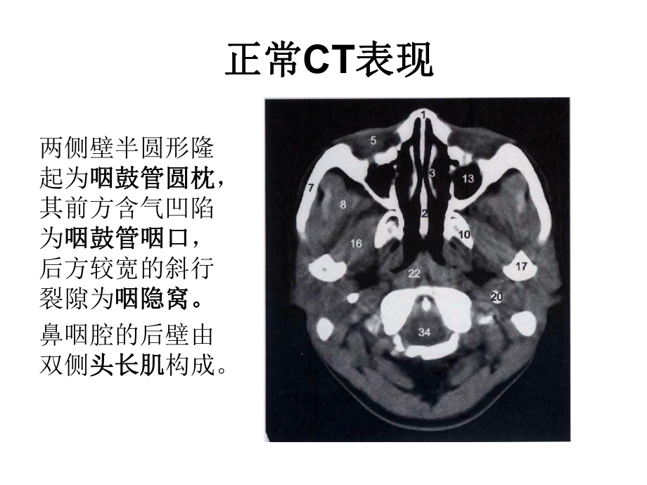 鼻咽部纤维血管瘤优秀课件.ppt_第3页