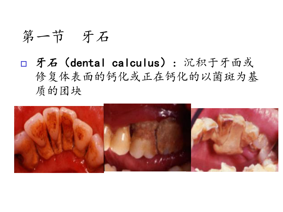 第六章牙周病的局部促进因素课件.ppt_第2页