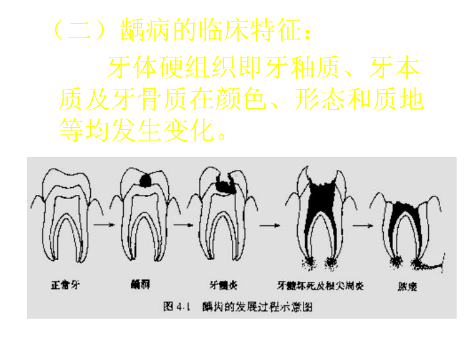 第四章牙体牙髓常见病第一节龋病课件.ppt_第3页