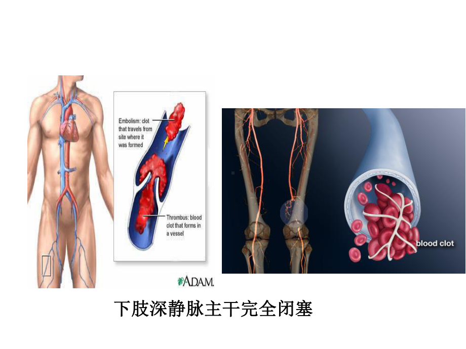 下肢深静脉血栓(成稿)课件.ppt_第3页