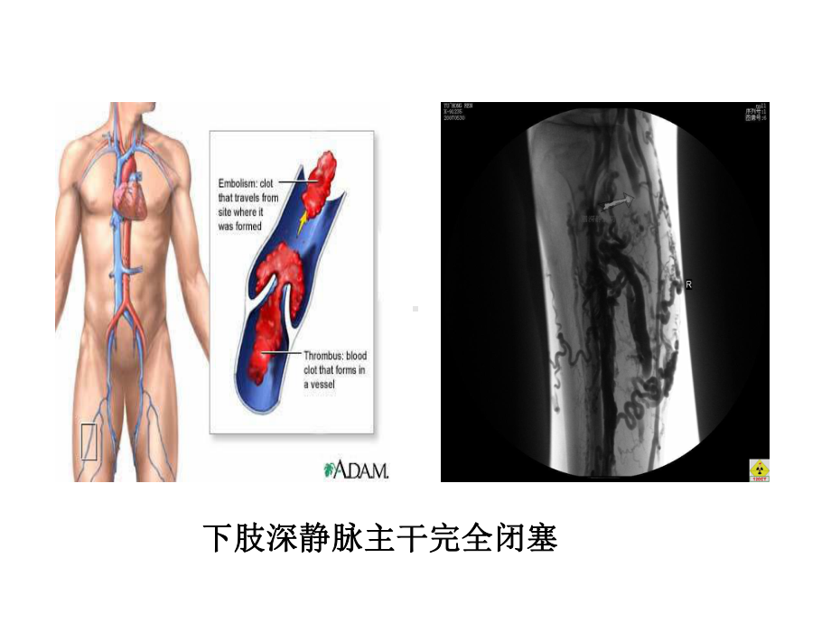 下肢深静脉血栓的护理课件.ppt_第3页