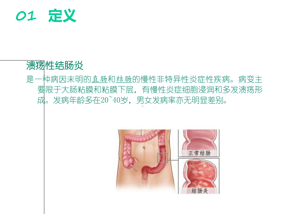 (完整)溃疡性结肠炎教学查房ppt.ppt_第2页