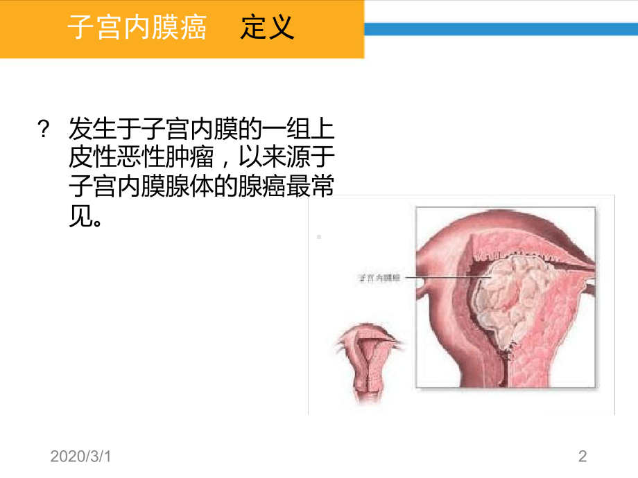 子宫内膜癌病人护理课件.ppt_第2页