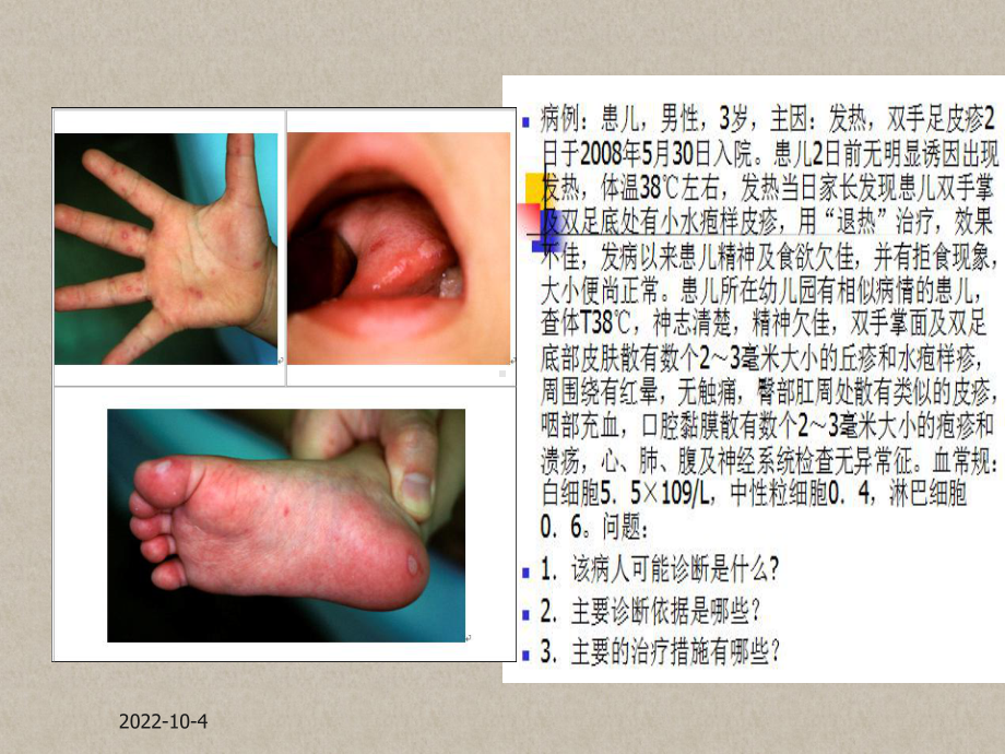 《手足口病》课件2.ppt_第1页