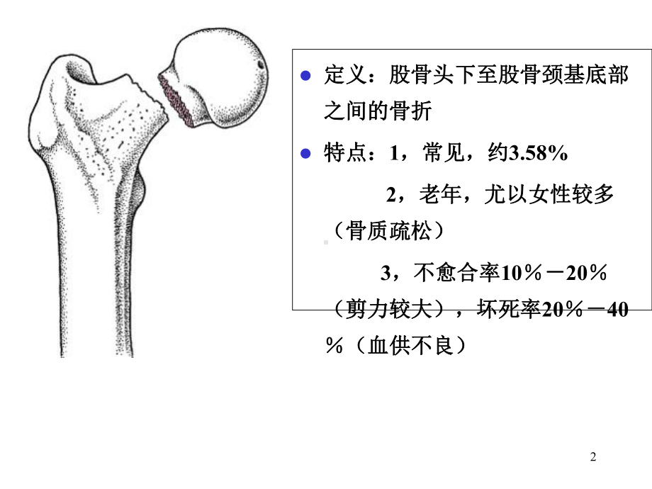 影像学-股骨颈骨折.ppt_第2页