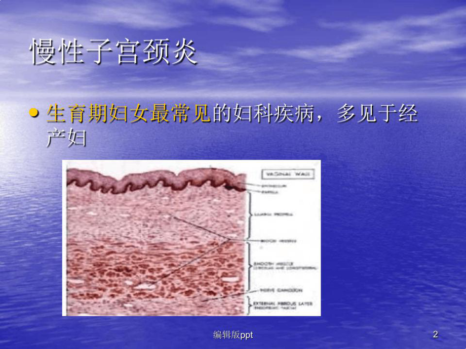 常见疾病女性生殖系统疾病课件.ppt_第2页